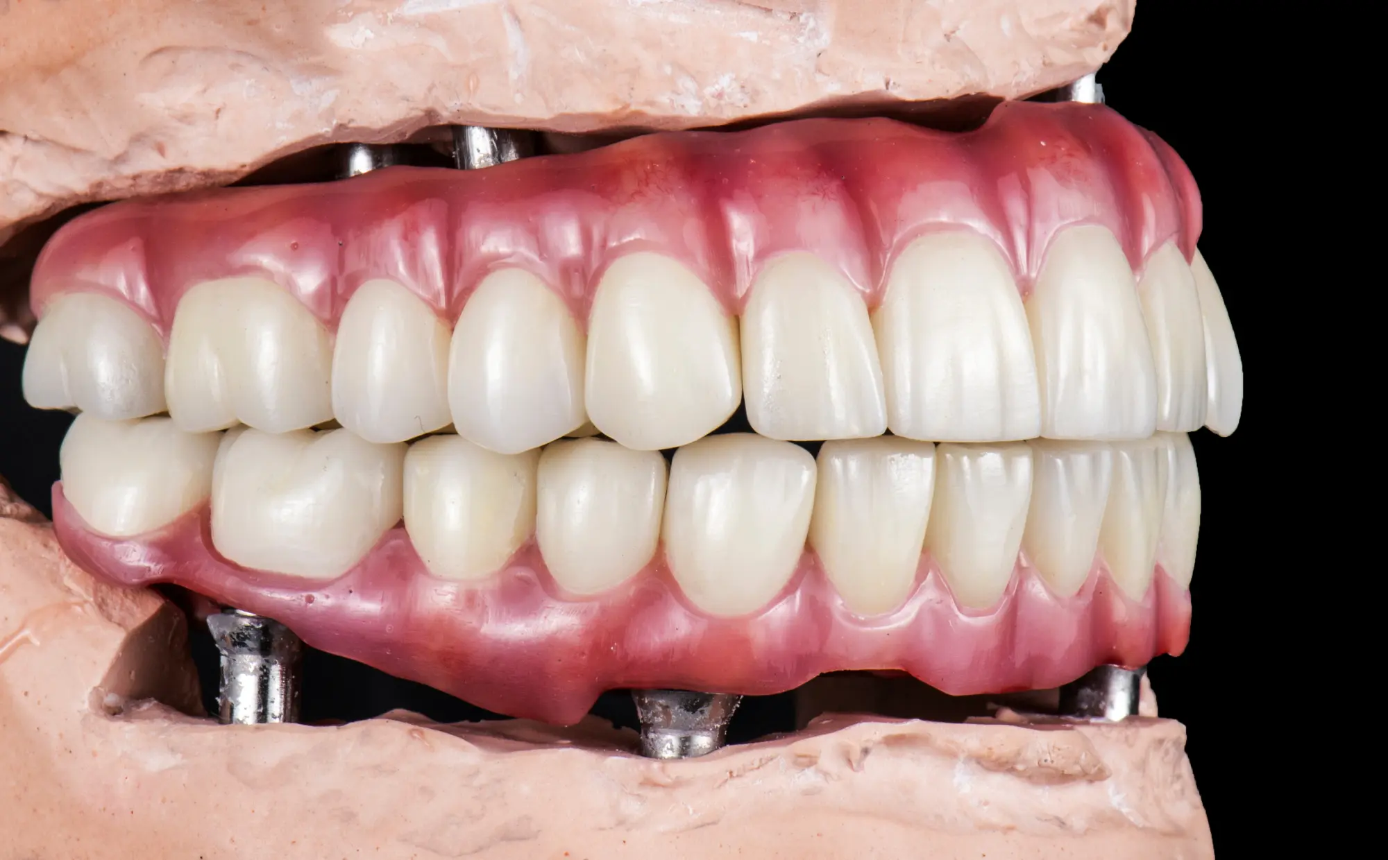 Full arch dentistry treatment planning