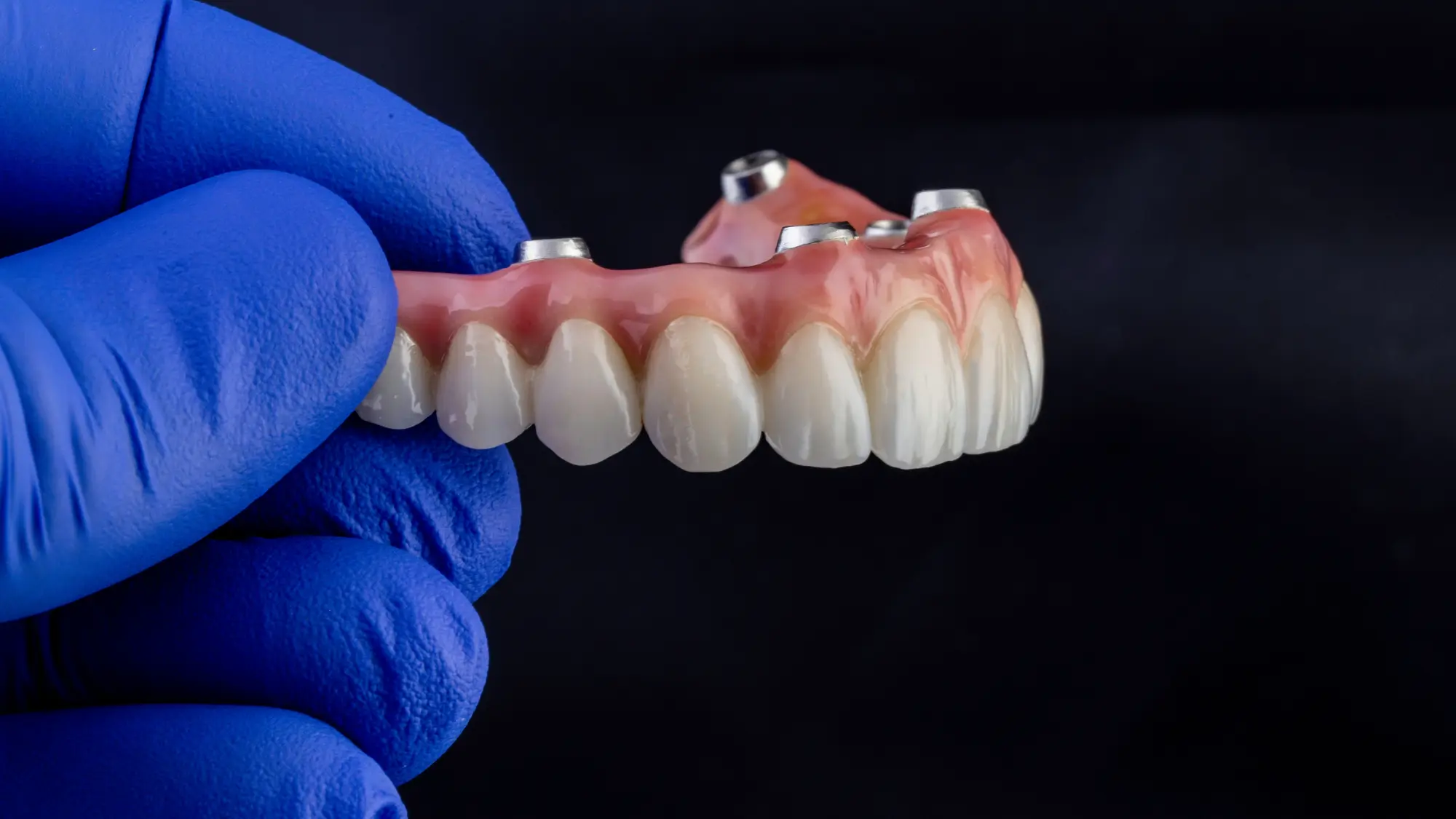 Full arch dental restoration detail