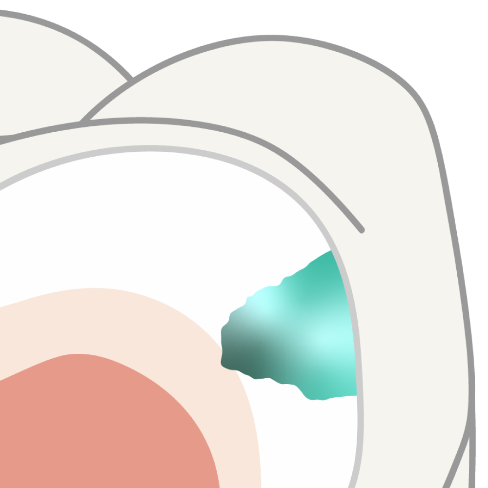 Illustration showing an early non-cavitated caries lesion within tooth enamel