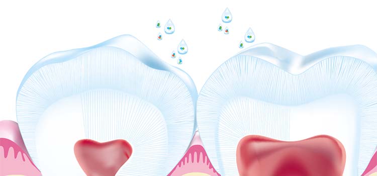 Early enamel lesion before Curodont treatment