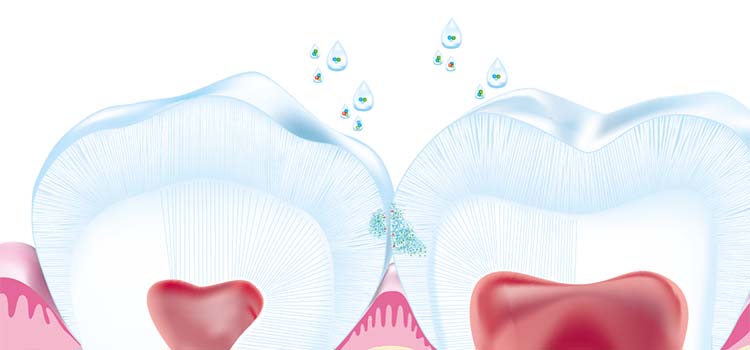Curodont biomimetic treatment entering an early enamel lesion