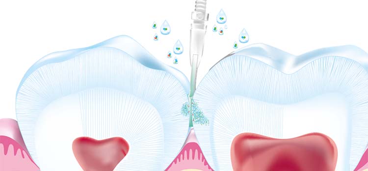 Enamel remineralization process supported by Curodont treatment