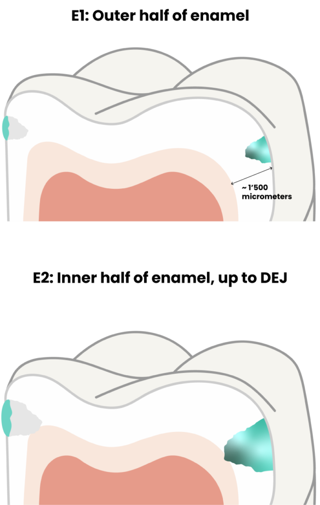 Diagram comparing different stages of early enamel caries lesions