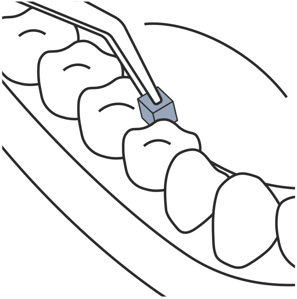 Illustration demonstrating the clinical application of Curodont on a tooth