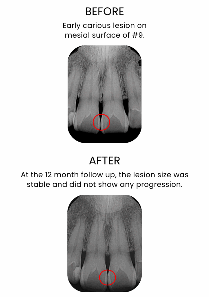 Clinical radiographic example showing changes in an early caries lesion following treatment